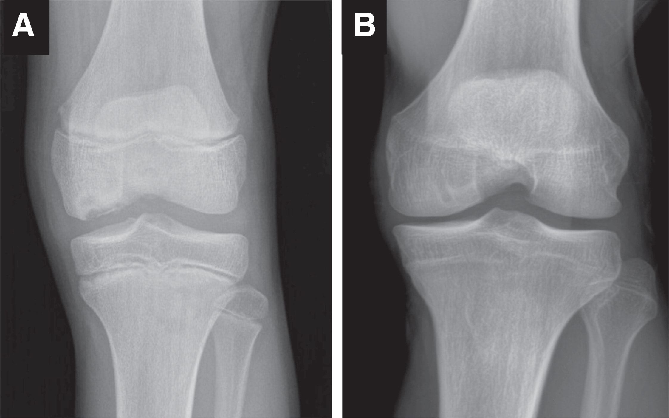Knee Implant